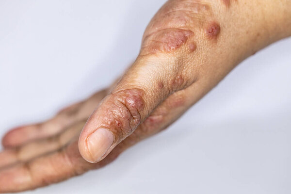 Background of human skin with Dust Mite Allergy.