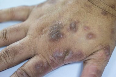 İnsan vücudunda Atopik dermatit ve mantar hastalığı deseni.