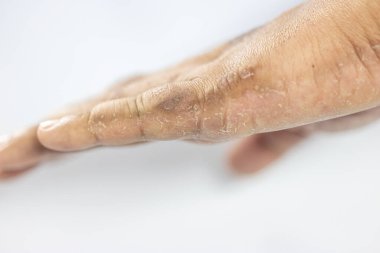 İnsan vücudunda Atopik dermatit ve mantar hastalığı deseni.