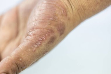 İnsan vücudunda Atopik dermatit ve mantar hastalığı deseni.