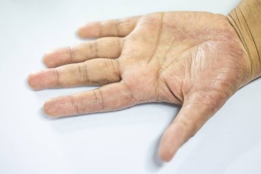 İnsan vücudunda Atopik dermatit ve mantar hastalığı deseni.