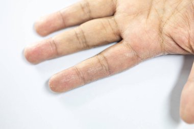 İnsan vücudunda Atopik dermatit ve mantar hastalığı deseni.