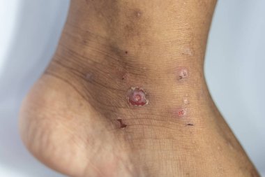 İnsan vücudunda Atopik dermatit ve mantar hastalığı deseni.