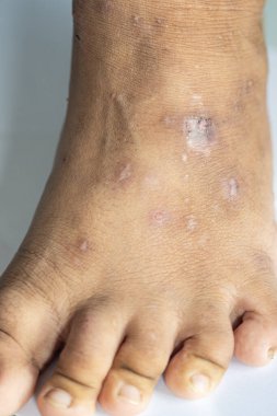 İnsan vücudunda Atopik dermatit ve mantar hastalığı deseni.