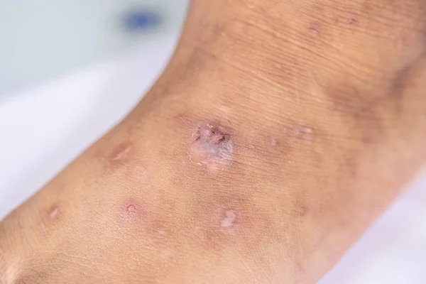 Muster Atopischer Dermatitis Und Pilzerkrankungen Menschlichen Körper Stockfoto