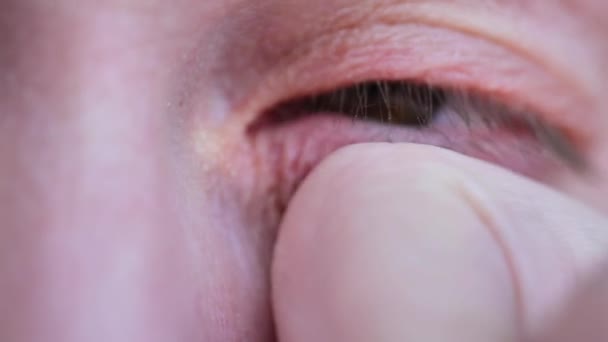 Oční Onemocnění Zánět Očního Víčka Prst Mnul Bolavé Oko Detailní — Stock video