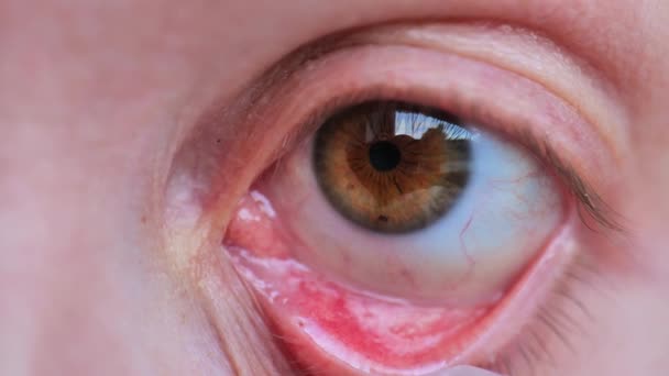 Entzündung Des Augenlids Finger Ziehen Rotes Augenlid Nach Unten Nahaufnahme — Stockvideo