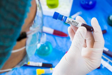 Mpox enfeksiyon testi, doktorlar yüz ve el tüplerinde mavi arka planda kan var. Stüdyo çekimi.