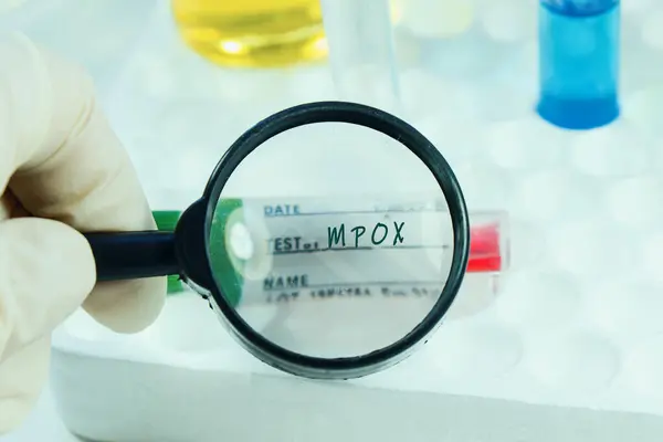 Mpox maymun çiçeği virüsü, laboratuvar ve kan testi tüpü