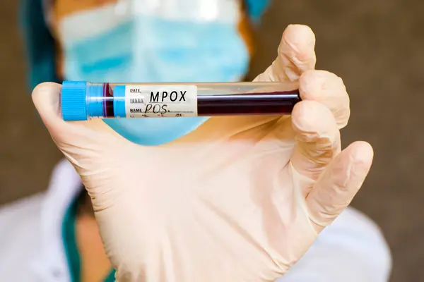 Mpox pozitif test örnekleri. Teşhis ve laboratuvar. Doktorlar eldivenle kafa kafaya gidiyorlar. Stüdyo çekimi, beyaz arkaplan.