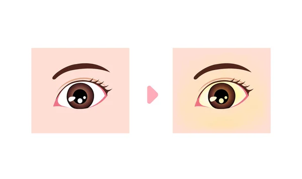 正常眼与黄疸眼的对比说明 — 图库矢量图片
