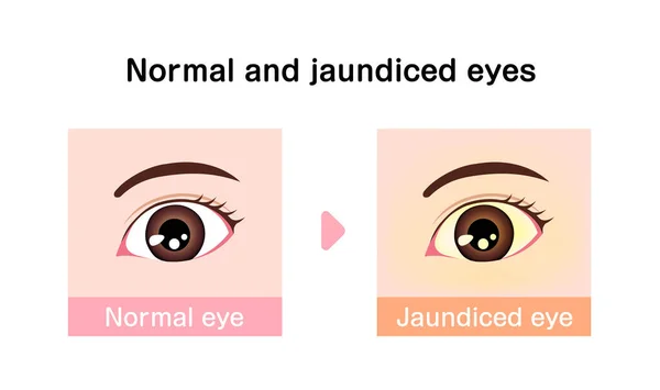 正常眼と黄疸眼の比較図 — ストックベクタ