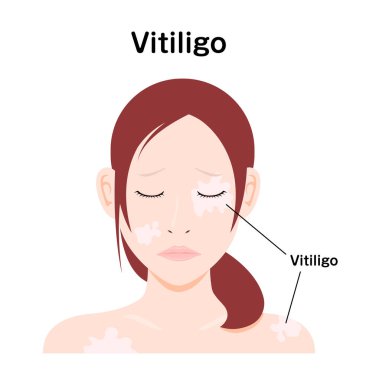 Vitiligo vektör çiziminin belirtileri