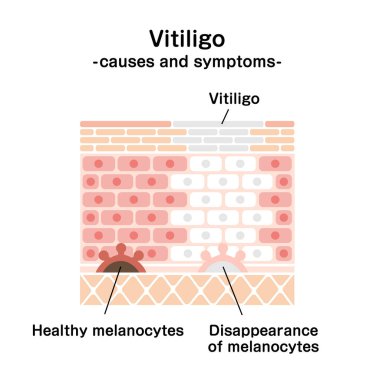 Causes and symptoms of Vitiligo vector illustration clipart