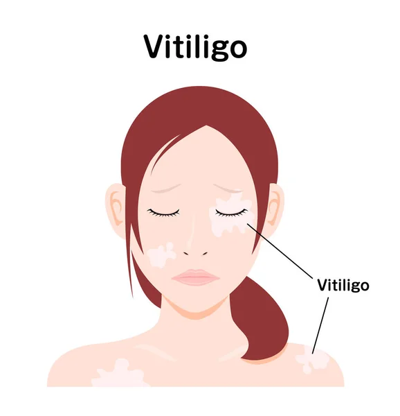 Symptome Von Vitiligo Vektor Illustration — Stockvektor