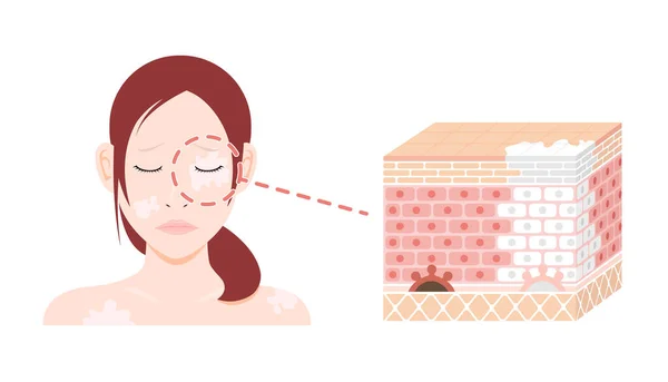 Ursachen Und Symptome Von Vitiligo Vektor Illustration — Stockvektor