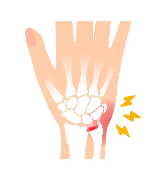 Stock vector About TFCC injury. Vector illustration