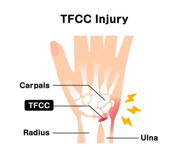 Про Травму Tfcc Векторні Ілюстрації — стоковий вектор