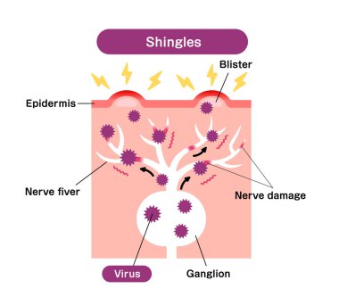 Kiremit mekanizması (herpes zoster) vektör çizimi