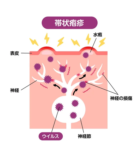 Mechanismus Der Gürtelrose Herpes Zoster Vektorillustration — Stockvektor