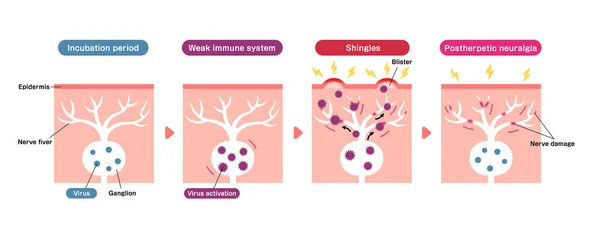 带状疱疹 带状疱疹 载体图例 包括热后神经痛 的发病机制 — 图库矢量图片
