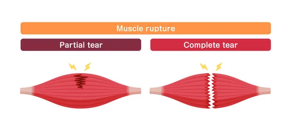 Darstellung Des Vektor Muskelrisses Partielle Und Vollständige Risse — Stockvektor