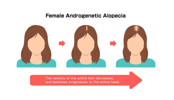 Dişi Androgenetik Alopecia Nın Gelişimi Vektör Illüstrasyonu — Stok Vektör