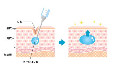 Hyaluronik asit enjeksiyonunun mekanizma çizimi (derinin çapraz görünümü)