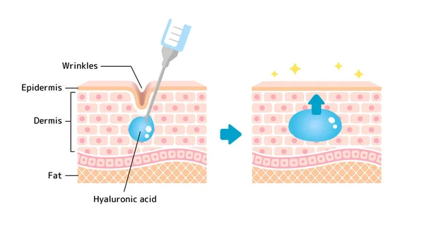 Illustration Des Mechanismus Der Hyaluronsäure Injektion Querschnitt Der Haut — Stockvektor