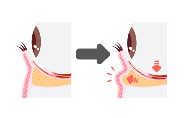 Yaşlanmanın yol açtığı siyah halkalar mekanizması. Çapraz kesitin vektör illüstrasyonu (metin yok )