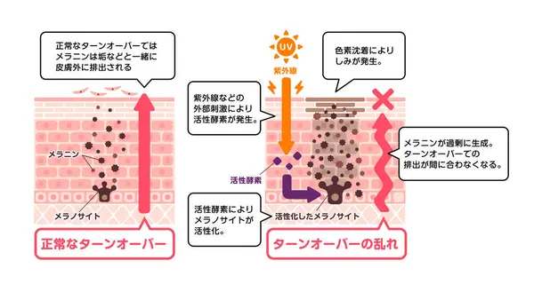 stock vector Vector illustration of how skin spots (hyperpigmentation) are created.