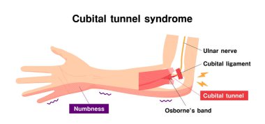 Kübital tünel sendromu vektör çizimi