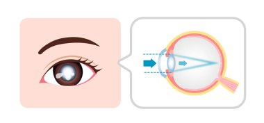 Causes and mechanism of cataract vector illustration clipart