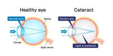 Katarakt vektör illüstrasyonunun nedenleri ve mekanizması