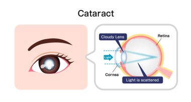 Causes and mechanism of cataract vector illustration clipart