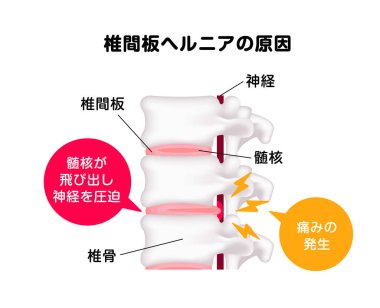 Omurga diski fıtık vektör çizimi