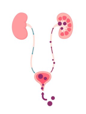 İdrar yolu enfeksiyonu vektör çizimi
