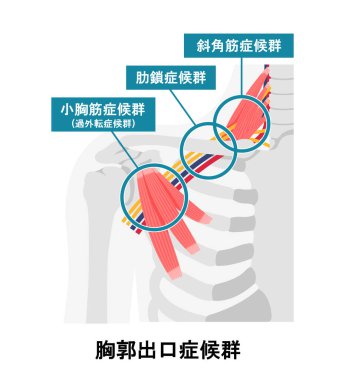 Vector illustration of where thoracic outlet syndrome occurs clipart