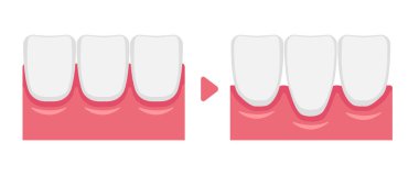Vector illustration of healthy gums and gingival recession