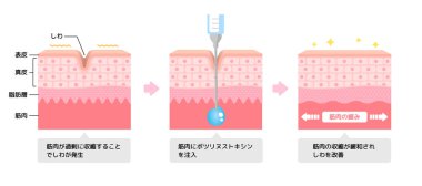 Botulinum toksin enjeksiyonuyla kırışıklık iyileştirme mekanizması