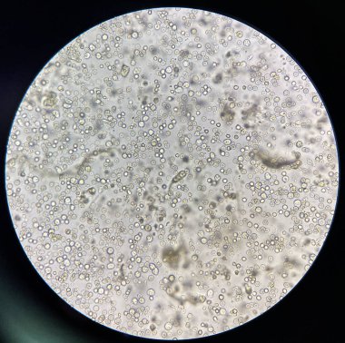 Orta dereceli turbi rbc ve wbc ve idrar bakterisi.