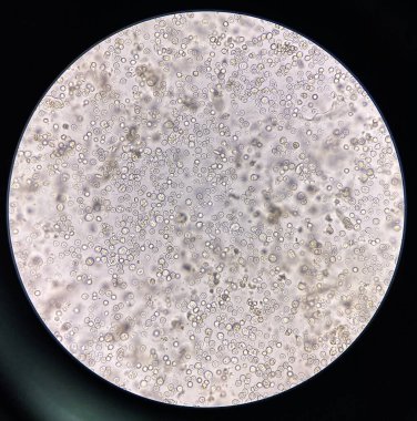 Orta dereceli turbi rbc ve wbc ve idrar bakterisi.