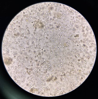 Orta dereceli turbi rbc ve wbc ve idrar bakterisi.