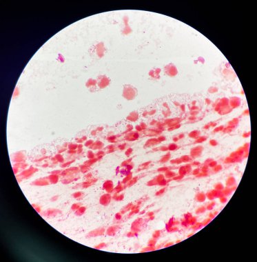 Vajinal smeardaki gram-negatif diplokoksi. Belsoğukluğu, Neisseria gonorrhoeae bakterisinin neden olduğu cinsel yolla bulaşan bir hastalıktır.