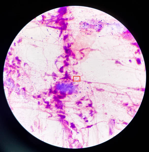 Gram Negatív Diplococcusok Hüvelyi Kenet Gonorrhea Egy Szexuális Úton Terjedő — Stock Fotó