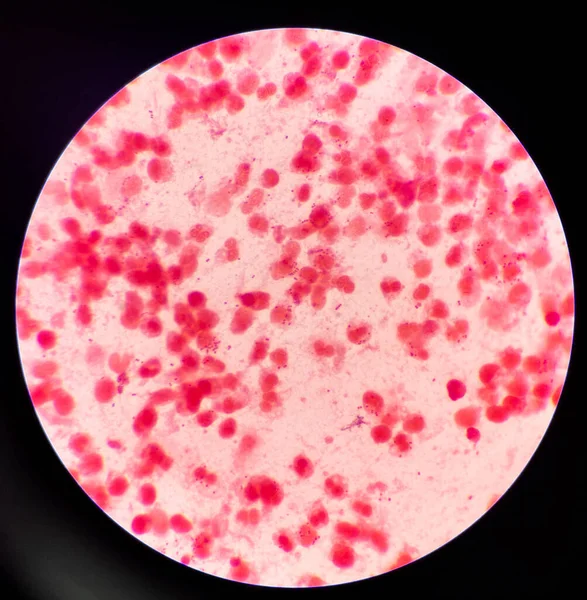 Gram Negatív Diplococcusok Hüvelyi Kenet Gonorrhea Egy Szexuális Úton Terjedő — Stock Fotó