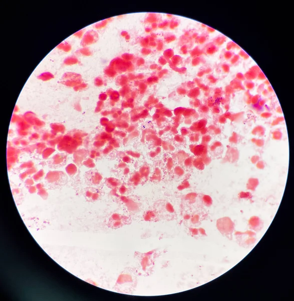 Vörös Sejt Alakú Gram Negatív Diplococcusok Hüvelykenetben Gonorrhea Egy Szexuális — Stock Fotó
