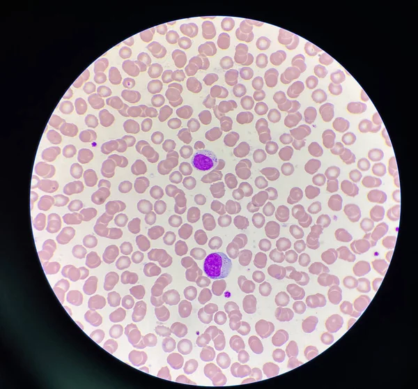 Linfócitos Grandes Células Vermelhas Sangue Fundo — Fotografia de Stock