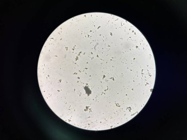 Calcium phosphate crystal in urine laboratory.
