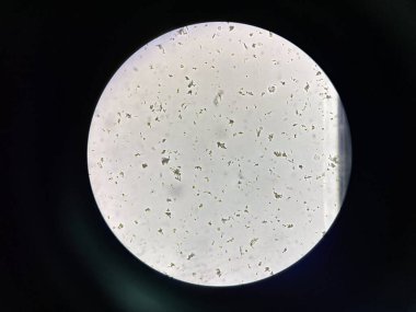 Calcium phosphate crystal in urine laboratory.